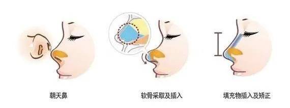双眼皮|顾客要整成明星？参考这个照着做就行了