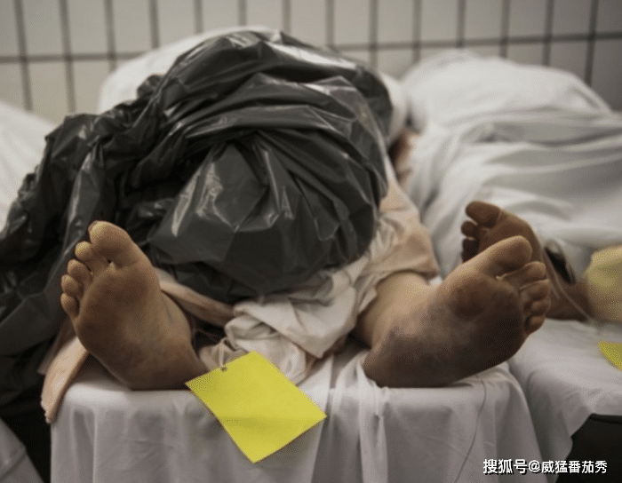 67手术宣告死亡拉进停尸间女子躺一晚竟复活伸手抓人吓坏女员工
