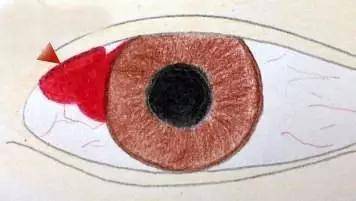 检查|为什么眼底会出血？