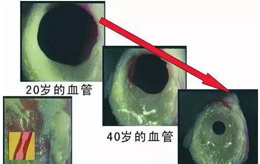 高血壓高血脂腦梗心梗動脈粥樣硬化根本病因是