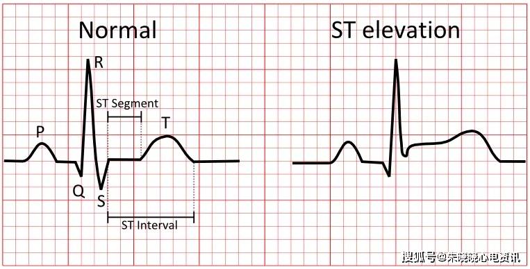 提到st段抬高,我们会首先想到急性心梗的特征性心电图改变——st段弓
