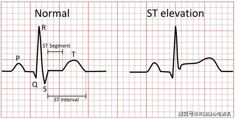 心电图J点抬高图片