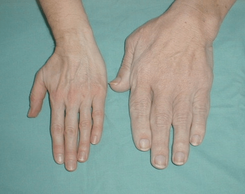 警惕!这可能是垂体瘤搞的鬼