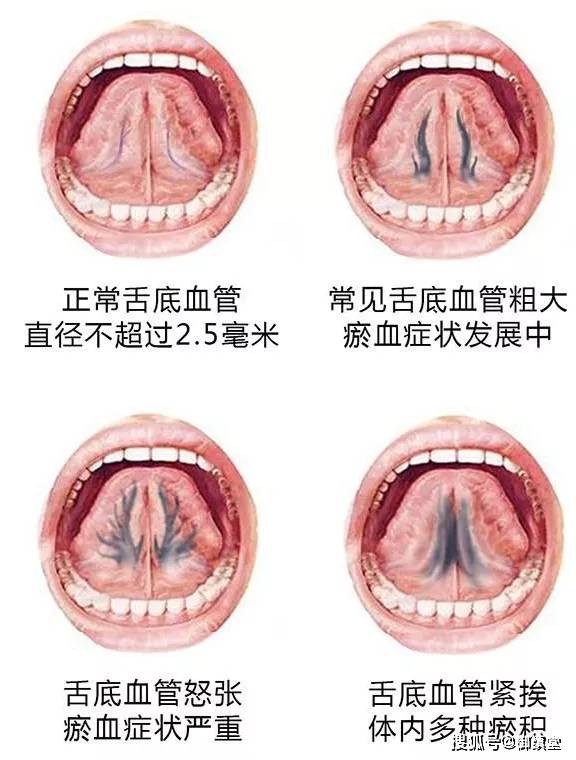 舌头下面青筋正常图片图片