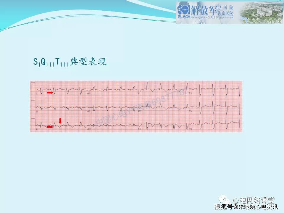 肺栓塞心电图表现及鉴别诊断