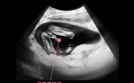 四个月女孩胎儿性别图图片