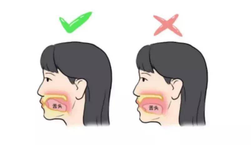 而張口呼吸時舌體和下巴會一起下沉舌尖會自然地頂往上顎粘膜皺襞正常