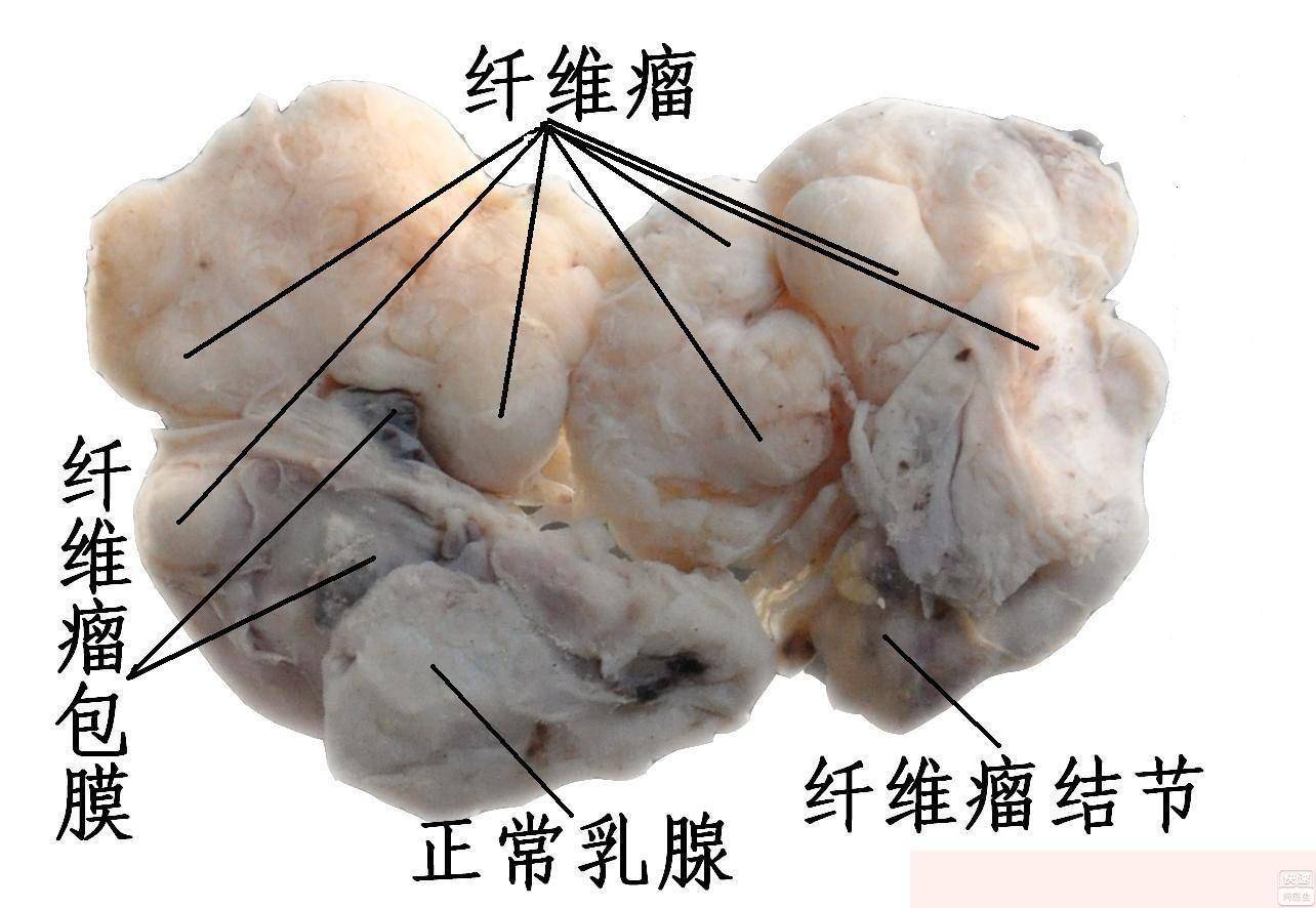 乳腺纤维瘤手术后图片图片