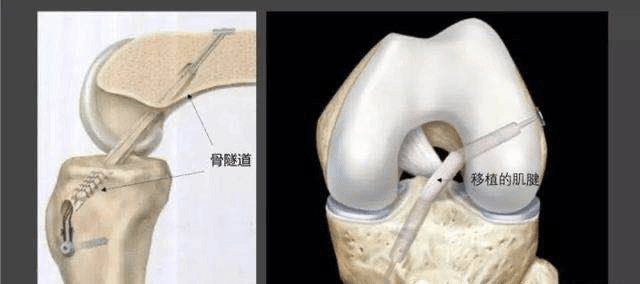 骨科知识||前交叉韧带损伤