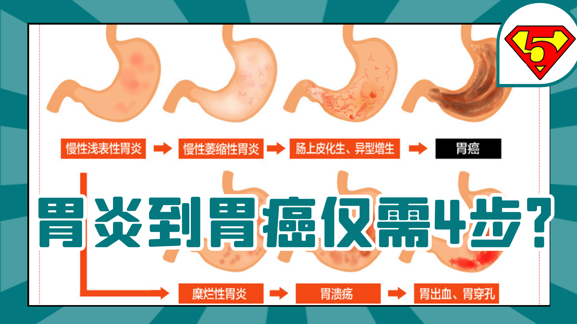 糜烂性胃炎伴幽门螺旋杆菌感染-京东健康