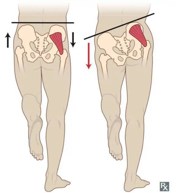 除了对下肢的影响以外,臀中肌薄弱还会导致腰部肌肉代偿的现象出现,久