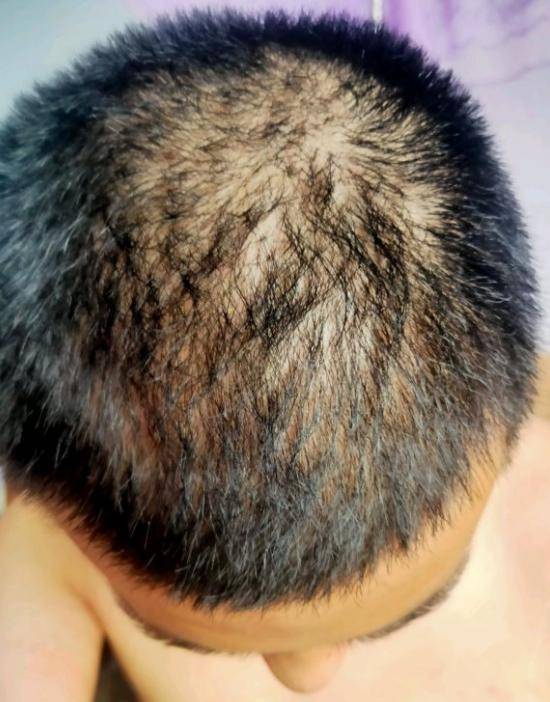 28岁男子头顶严重脱发,每次相亲一见面就黄,担心变成秃顶_手机搜狐网