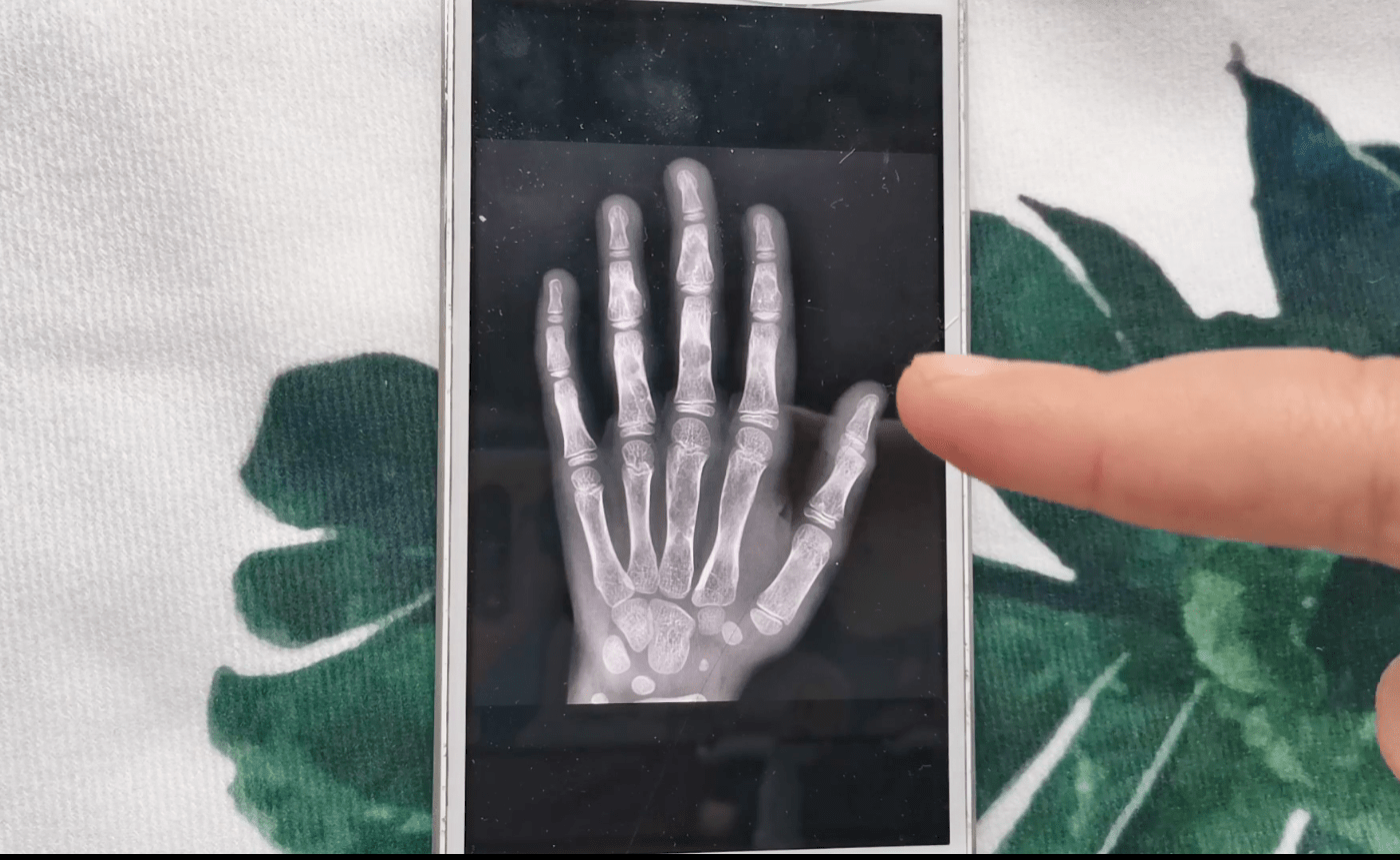 只要这样设置手机也能够x光扫描你的手指骨头一清二楚