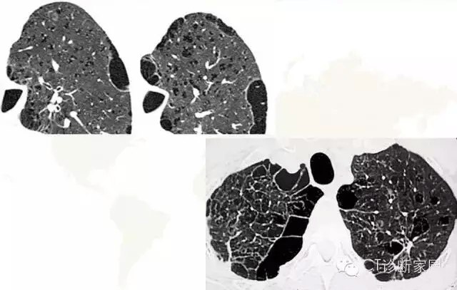 必看肺气肿ct分型