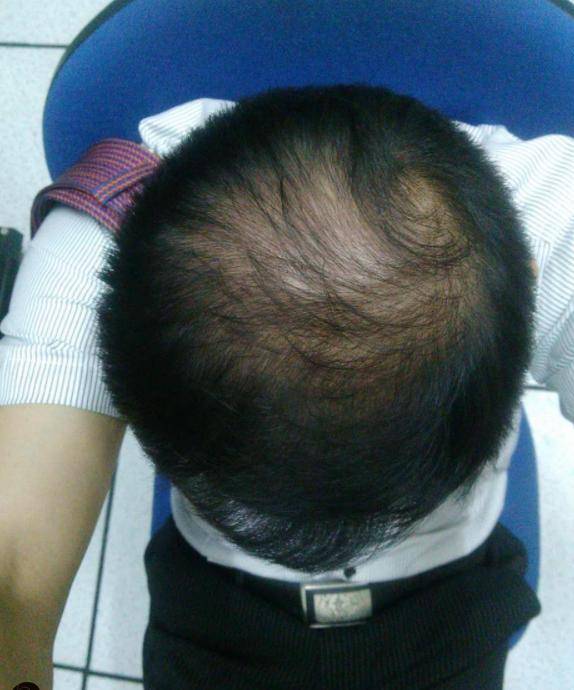 26岁男子遗传性脱发3年,对象都没找到,头却快要秃了