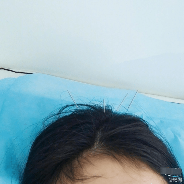 杨幂身体亮红灯在头上扎银针,晒照自侃能增强信号疑向魏大勋撒娇