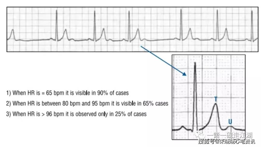 心电图u波明显图片