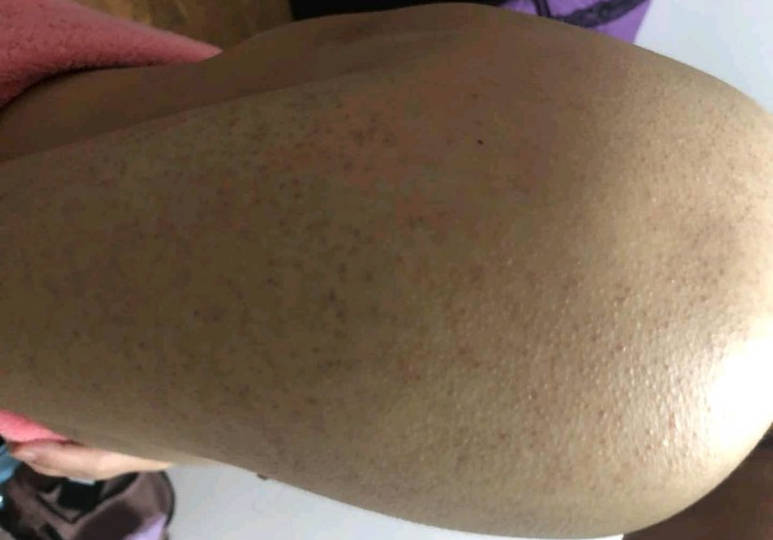 11男小孩皮肤长鸡皮肤(小孩子长鸡皮肤的图片大全) 11男小孩皮肤长鸡皮肤(小孩子长鸡皮肤的图片大全)