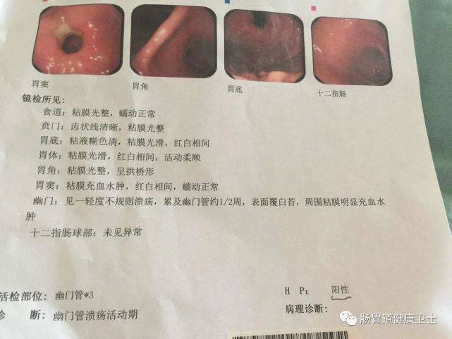 肠胃镜检查报告单图片图片
