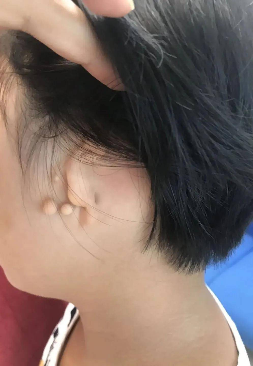 佛山惠耳助听器连锁机构卫国路店提醒您先天性小耳畸形该怎么选配