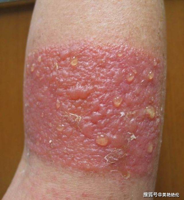 颜次方小知识膏药贴久了皮肤受损怎能办