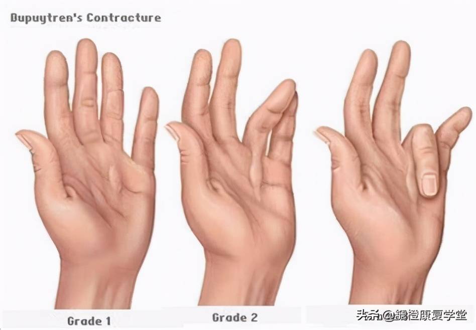 肘关节,膝关节僵硬屈曲是关节挛缩造成的吗?_手机搜狐网