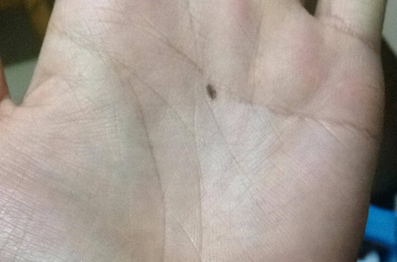 为啥多数孩子手心都有一颗"痣"?网友:没有铅笔痣的童年不完整