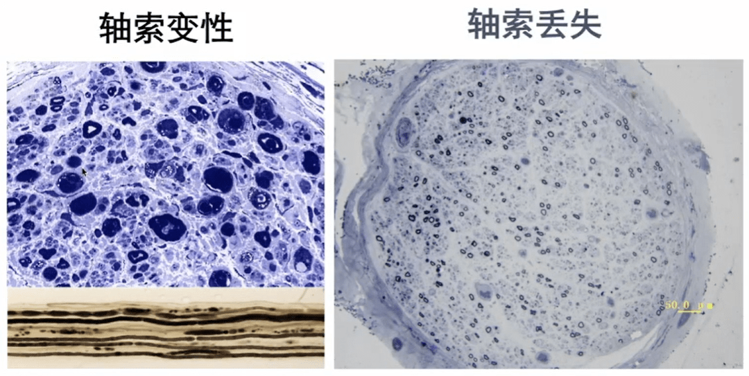 周围神经病的九大诊断步骤,请查收!