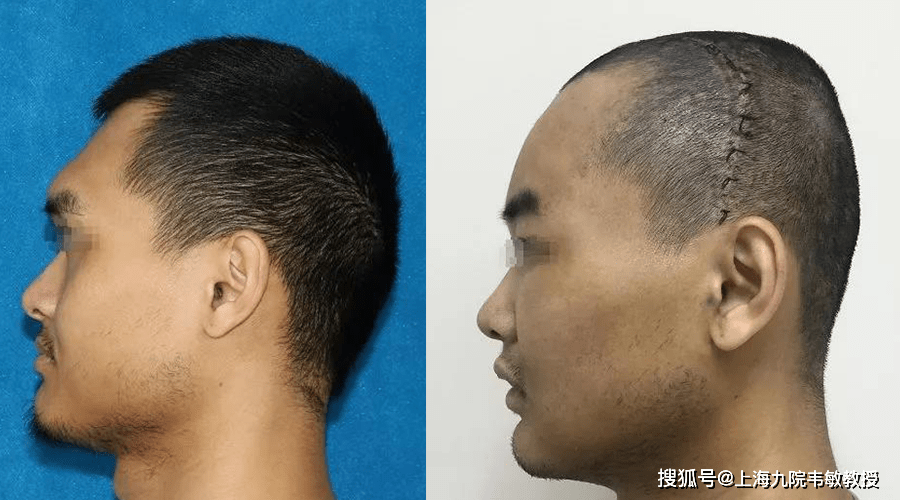 韦敏教授丨眉弓如何才算高是越高越好吗