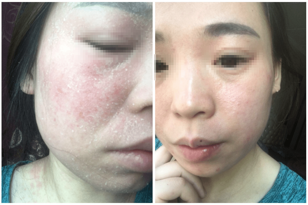 糖皮质激素为什么会毒害皮肤