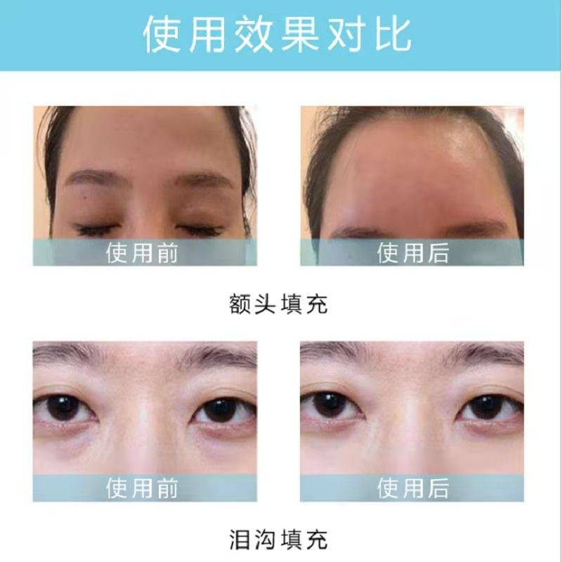 葡聚糖干细胞填充安全吗葡聚多肽细胞填充能维持多久