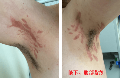 醇血症引起cushing综合征表现,例如向心性肥胖,痤疮,多毛,腹部紫纹