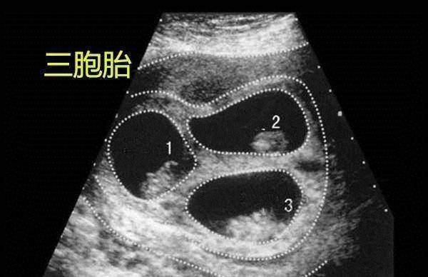 胎动总是在左边,就说明怀了男孩吗?胎宝宝"运动"是有原因的_胎儿