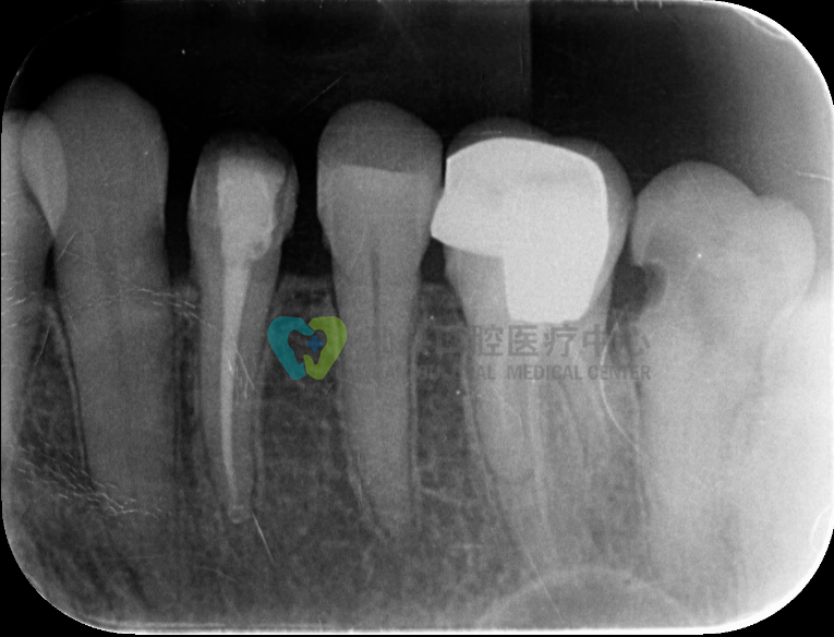 一例根管再治疗告诉你，规范化操作有多重要