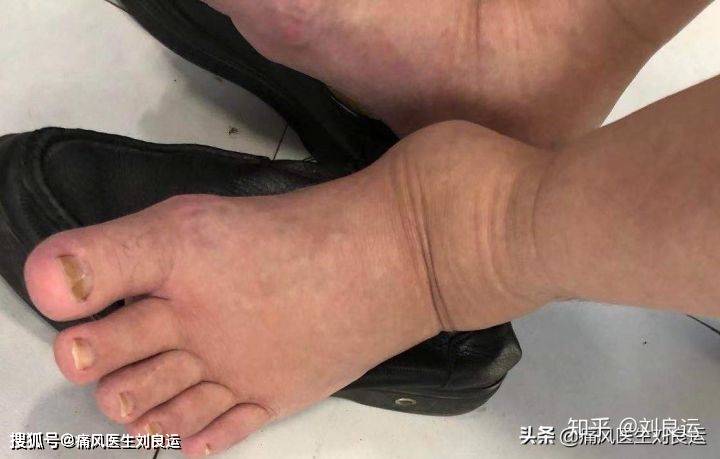 如果尿酸正常了,痛风结石会自己消除吗?