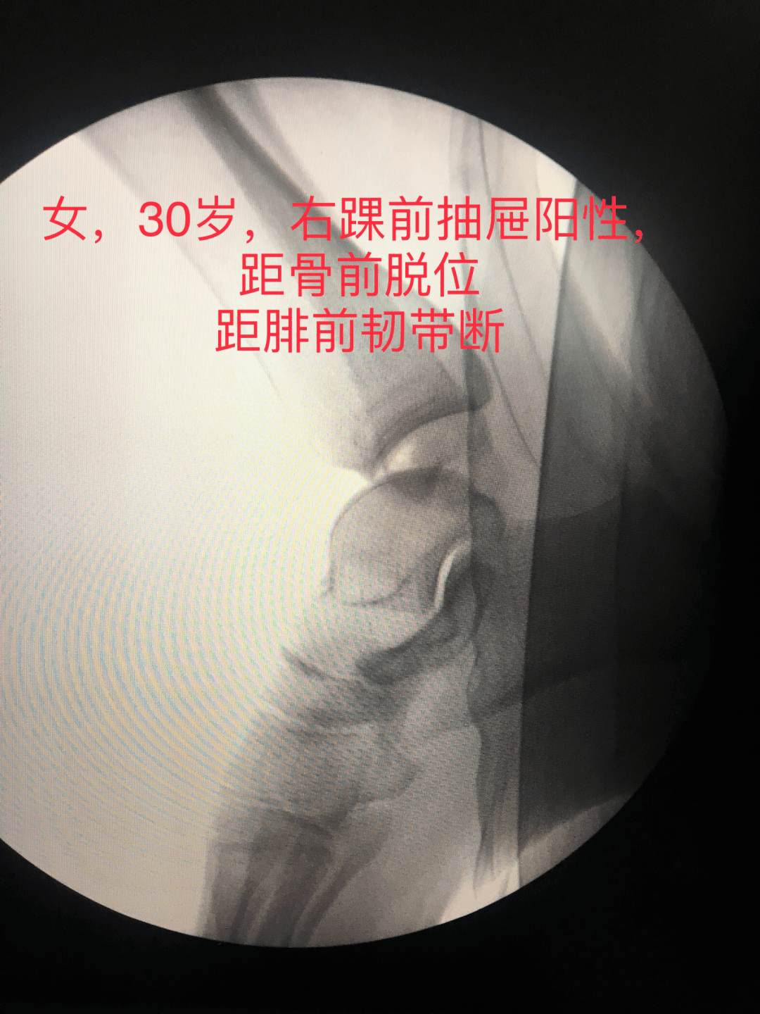 關節前抽屜試驗對比(圖3,4,5),證明術前彩超診斷:距腓前韌帶撕裂(圖6)