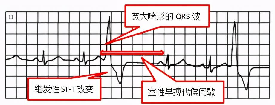 掌握常见心电图我的心脏我做主