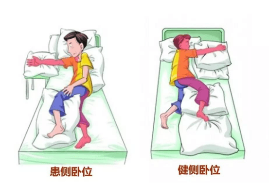 其次就是肩关节半脱位,在偏瘫患者中很常见.