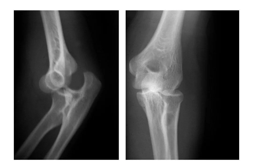 7种67肘部损伤x片详细图解