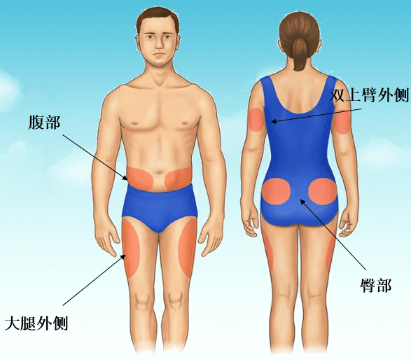 臀部外上侧手臂外侧四分之一部分只能由前面或外侧面进行大腿注射