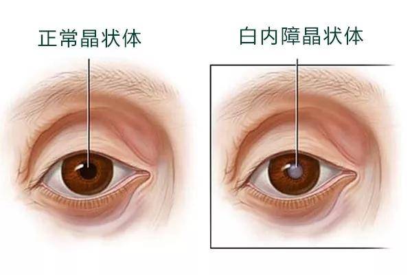 白内障的类型图片图片