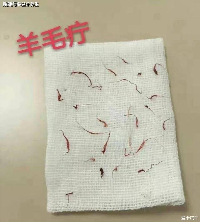 羊毛疔的症状及特点