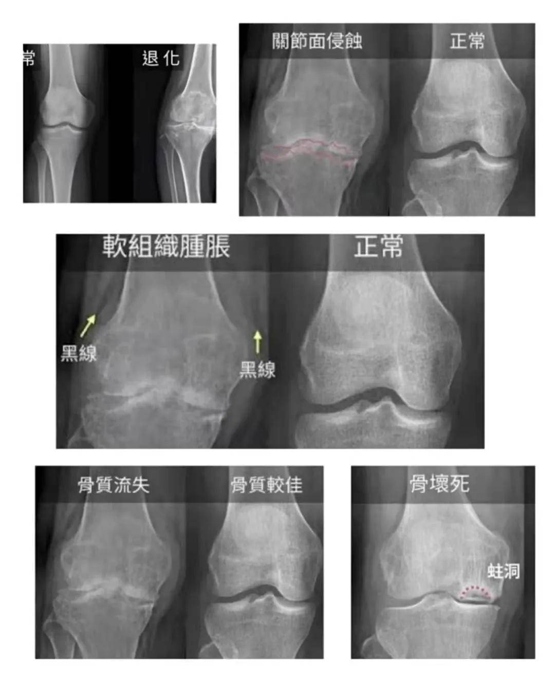 kellgren轻微骨赘(i级)