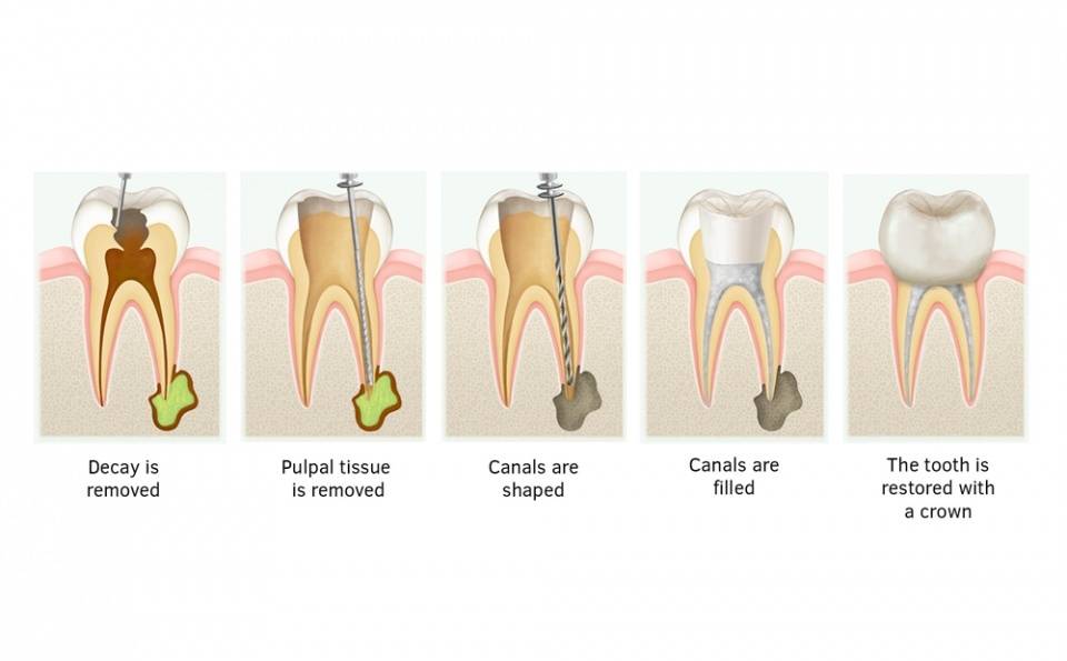 什麼是根管治療牙齒出現這些情況防止爛牙建議做根管治療
