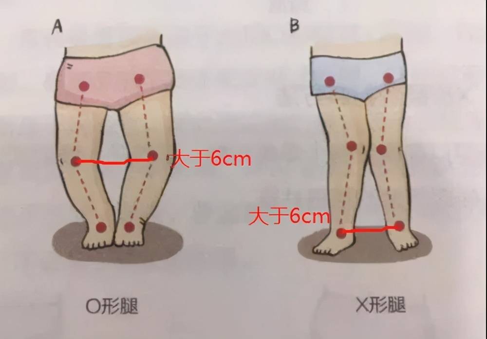 o型腿测量标准图图片