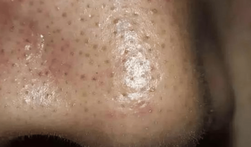 黑头密密麻麻趴在鼻子上影响颜值送你3招清除黑头皮肤光滑