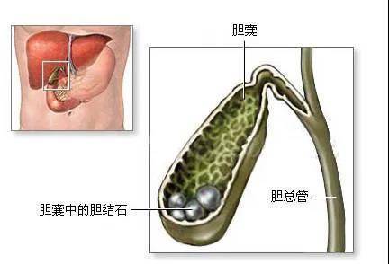 會發現膽囊結石,此時,膽囊內的結石與人體相安無事,和平共處,並未帶來