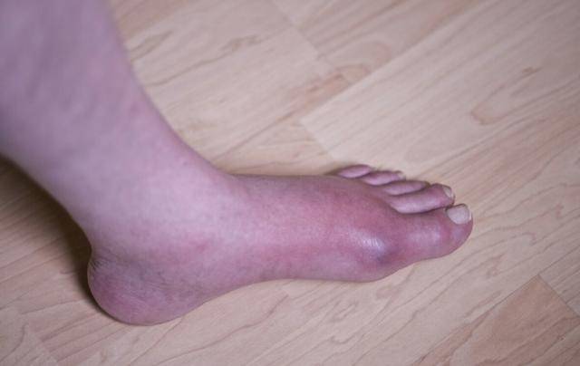 尿酸偏高的人厨房3种调味料不要吃了小心被痛风缠上