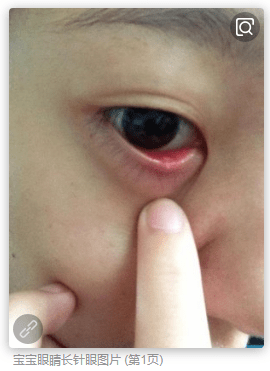 怎样防止婴儿患上针眼