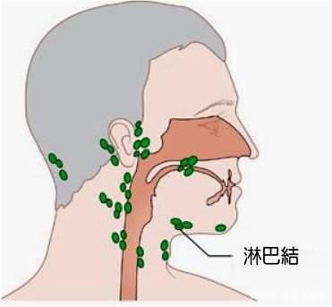 22岁小伙患恶性淋巴瘤!竟因这个习惯,很多人还在做